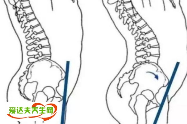 盆骨前傾