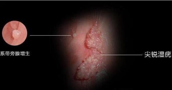 真實女性hpv感染初期圖，警惕低危型尖銳濕疣/高危型可發(fā)展成宮頸癌