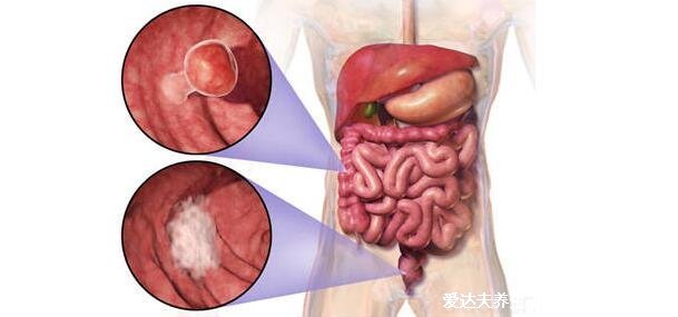 腸癌拉出來大便的圖片，警惕4個(gè)最為明顯的腸癌信號(hào)