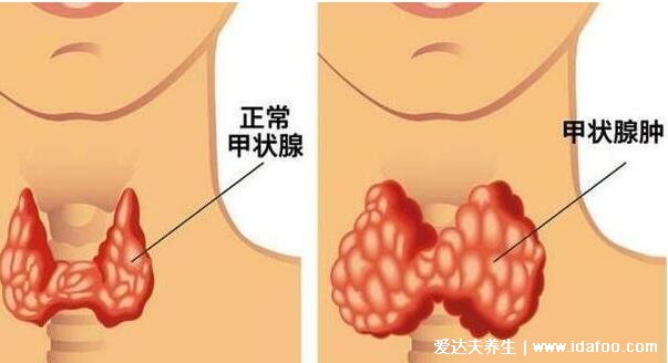 甲狀腺最怕2個(gè)水果，榴蓮/香蕉要慎吃加重甲狀腺結(jié)節(jié)