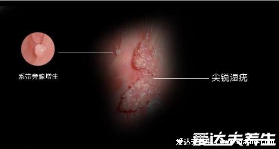 疣是什么樣子圖片，常見6種類型疣體(尋常疣/扁平疣/尖銳濕疣)