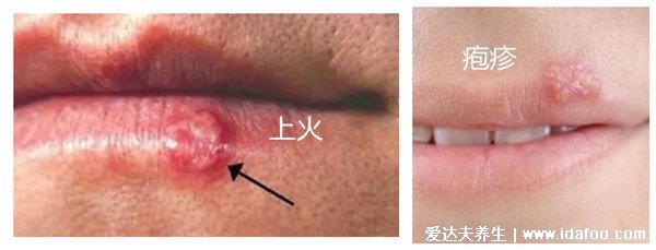 嘴上皰疹和上火水泡的區(qū)別圖，口唇皰疹成簇聚集會(huì)癢和灼熱