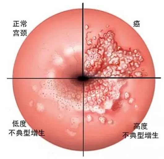 感染HPV病毒 就會惡變成宮頸癌嗎？造成宮頸癌的真正原因究竟是什么？