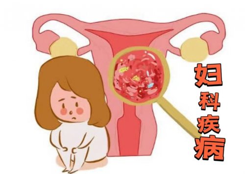 女性深受婦科病騷擾多半與這5個習(xí)慣有關(guān)需盡早改掉