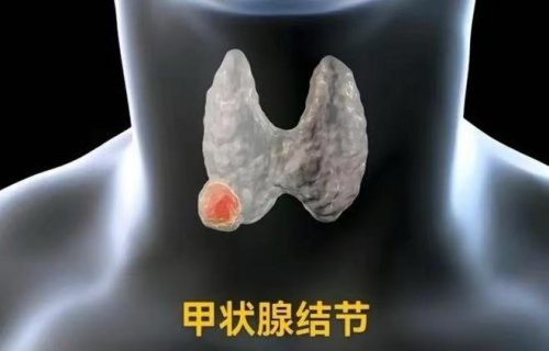 甲狀腺有結(jié)節(jié)的人起床常會有這3表現(xiàn)